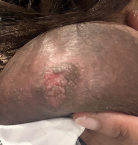 Pics of Nipple Warning! Day 3 of breastfeeding and have this on one breast