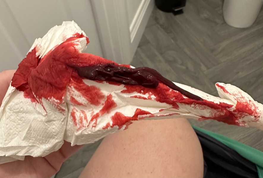 GW: Early miscarriage or just a clot?