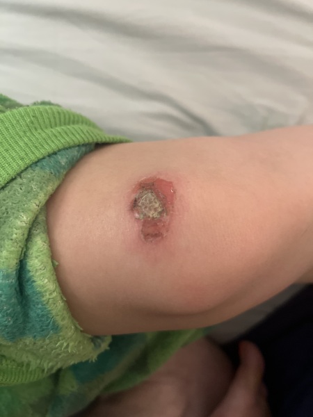 Does this wound look infected? Do I need to seek help tonight?