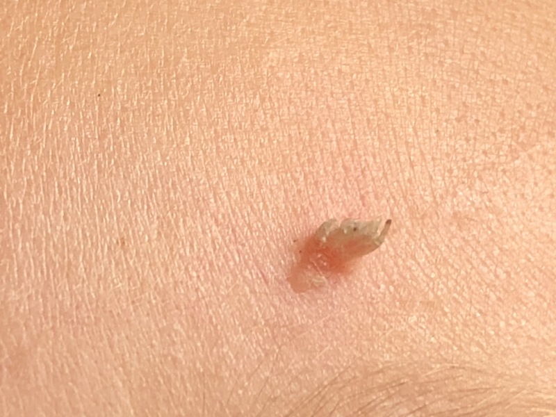 What is this on my daughters face