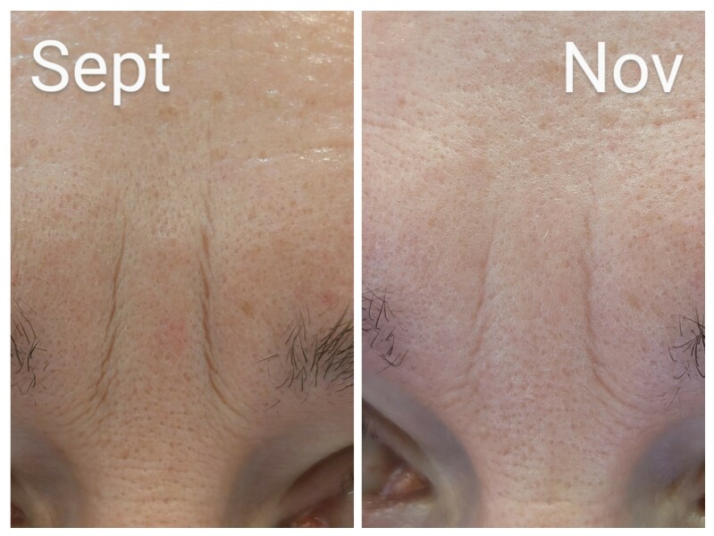 Tretinoin 0.006 - I think I can see an improvement already!! (Pic)