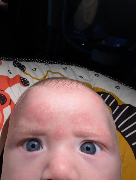 What is this on my sons head???