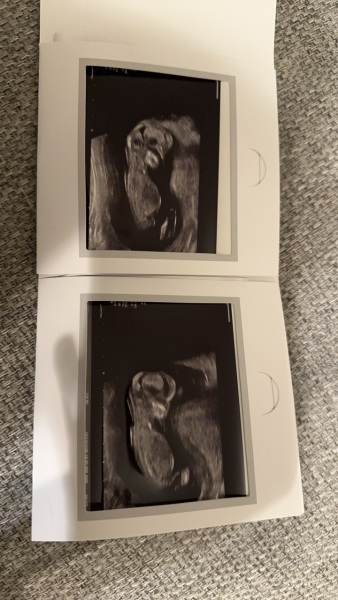 13 week pregnancy scan