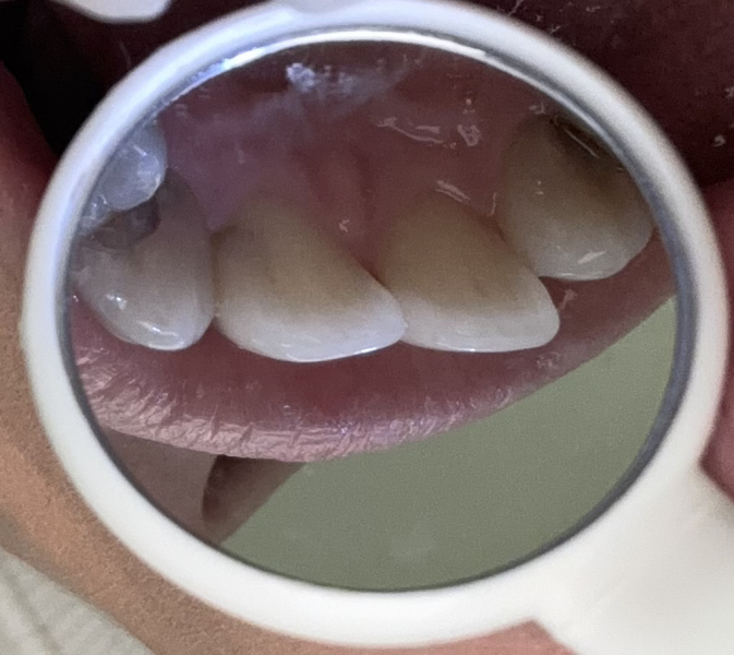 Dental cavities WORRIED