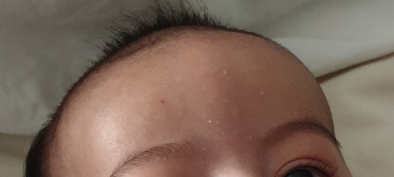 Ridge on babys forehead?