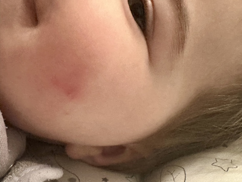 Worried about this rash/spot on babies face