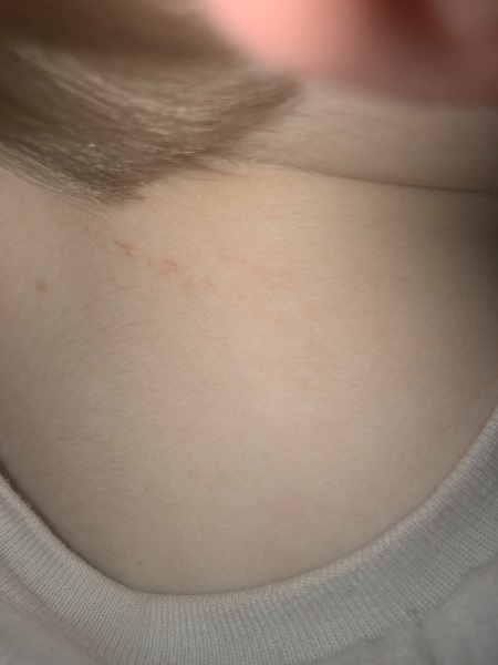 Tiny mark that doesn’t disappear on toddlers neck
