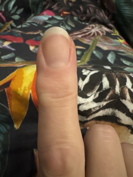 Anyone had a myxoid cyst?