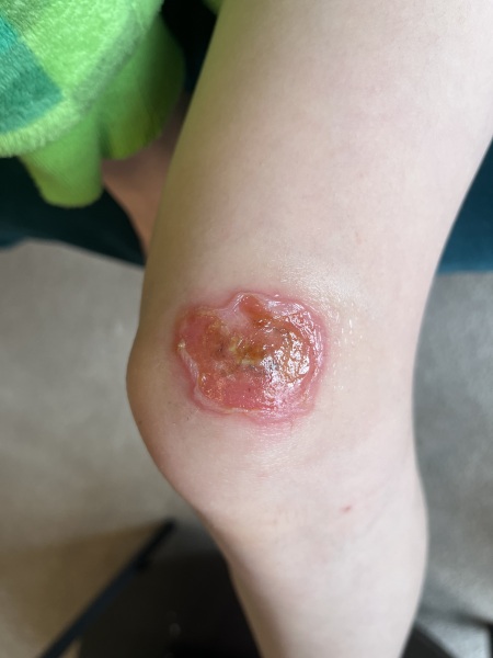 Does this wound look infected? Do I need to seek help tonight?
