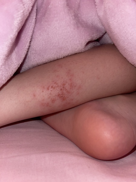 Shingles or bacterial infection? Photo attached