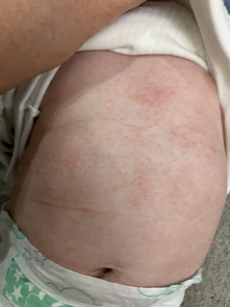 Rash on baby…any thoughts?