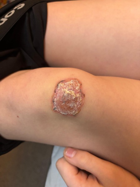 Does this wound look infected? Do I need to seek help tonight?