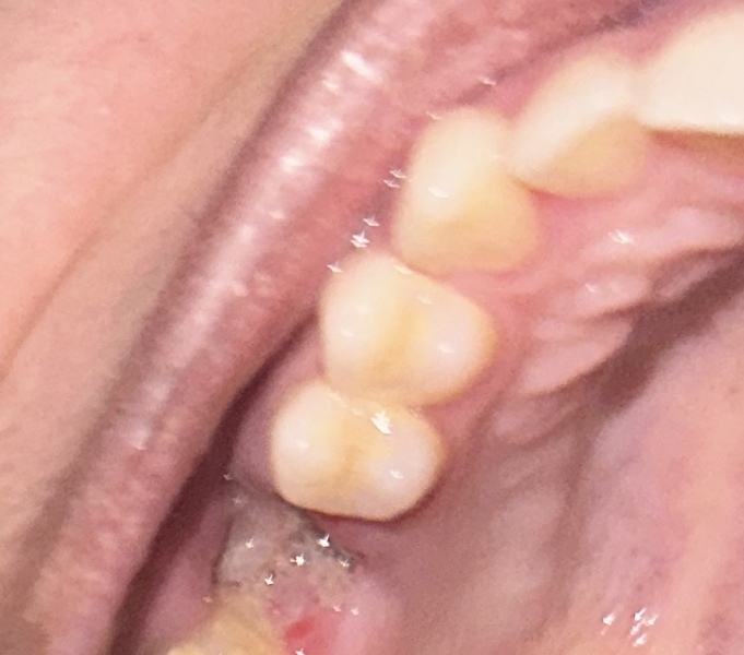 Dental extraction help!