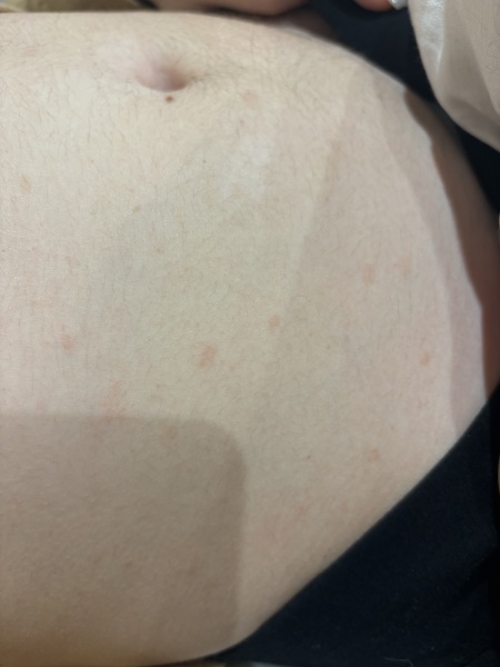 Help identify rash on teen please