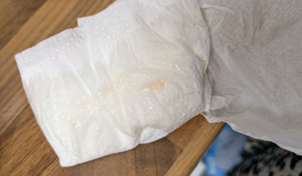 Is what I coughed up blood tinged?! (Photo) Virus/Asthma