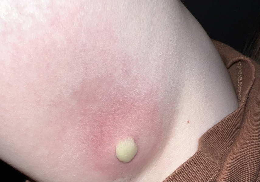 Lump in armpit - need advice!