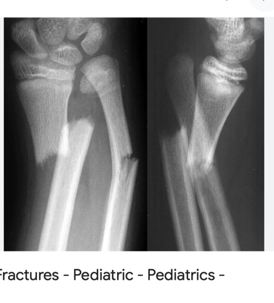 Need a vent- my 8 y/o broke his collarbone at school and no-one noticed