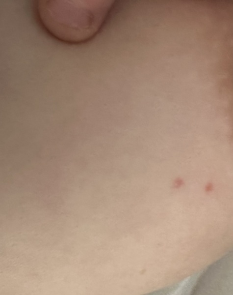 Red spots on breast