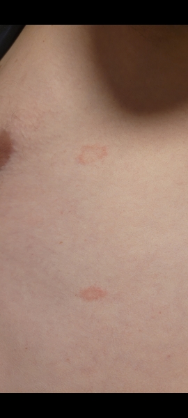 Is this ringworm?  Hives?