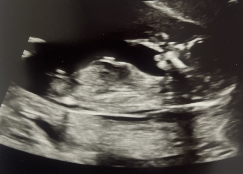 14 weeks scan - boy or girl?
