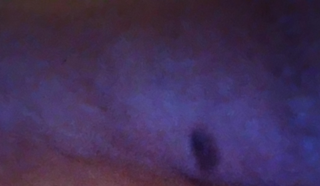 skin cancer?