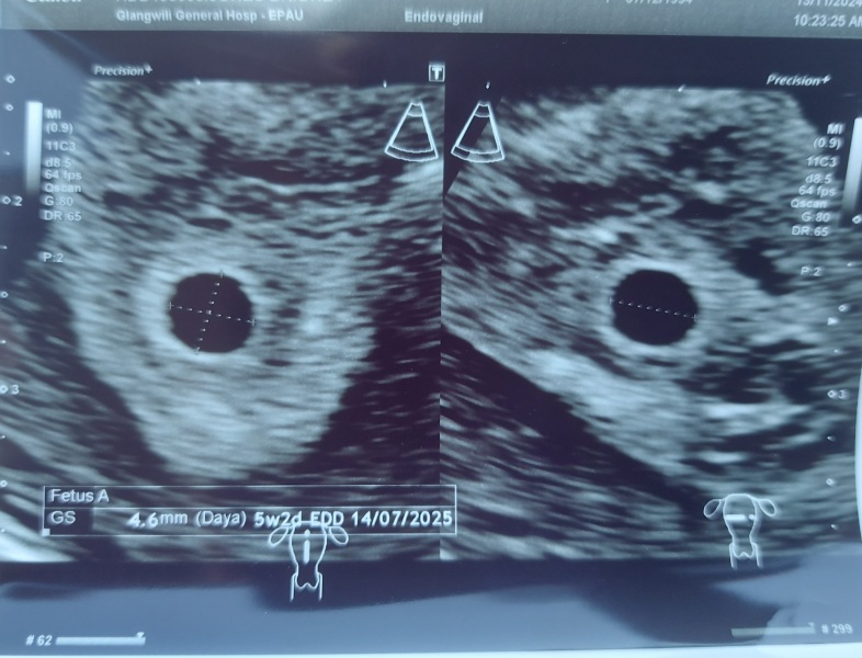 4 weeks 6 days, due 9 July 2024.. anyone wanna join?