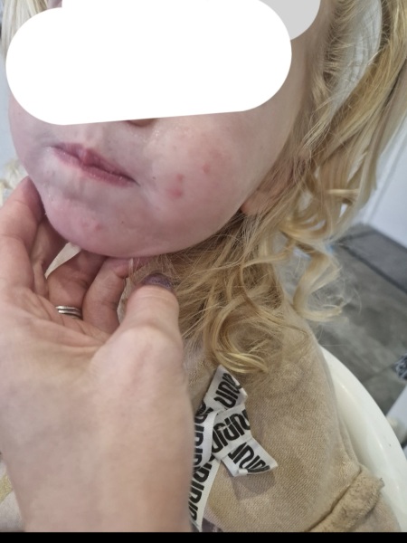 Chicken pox? Hand foot and mouth?