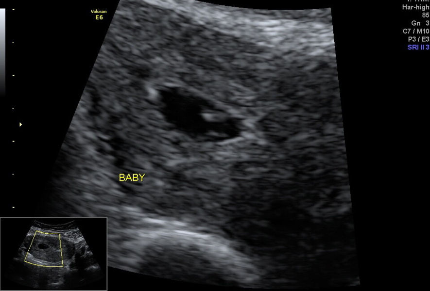 11DPO positive - but concerned