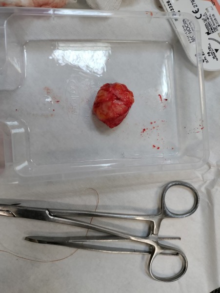 Mother of all sebaceous cysts