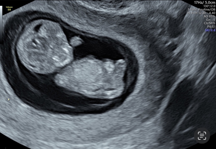 Is 10-11 weeks too early for nub theory?