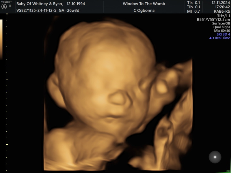Slight high amniotic fluid