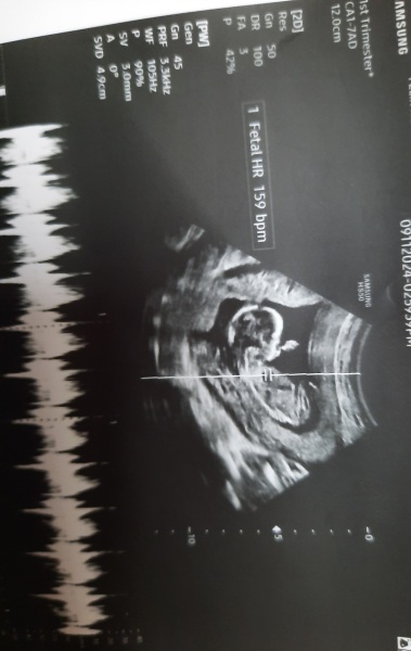 Ultrasound gender