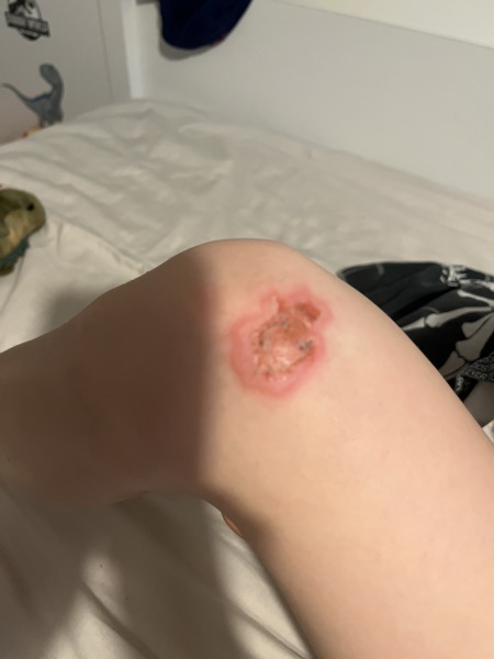Does this wound look infected? Do I need to seek help tonight?