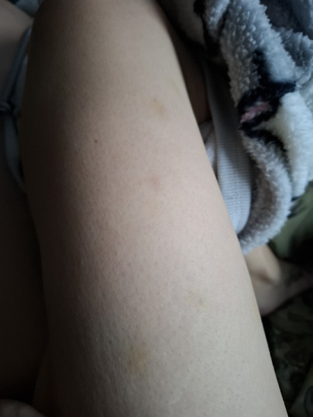 Bruises all over legs!