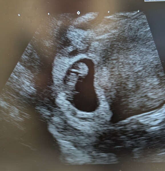 Pregnancy of unknown location, bleeding, but HCG doubling