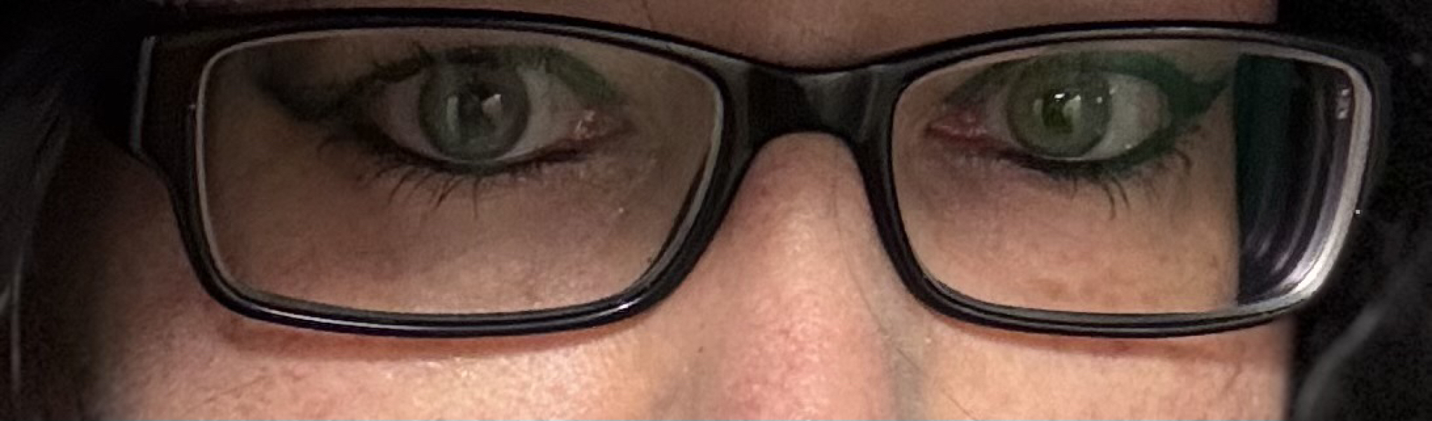 Baby with limited vision in one eye