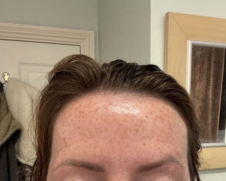 Tretinoin 0.006 - I think I can see an improvement already!! (Pic)