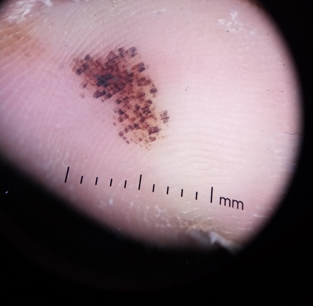 Melanoma on little toe? Picture attached.