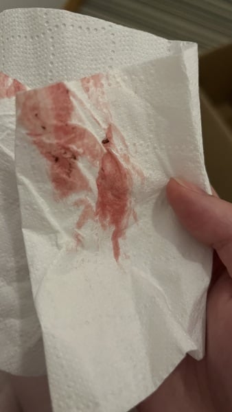 Has anyone had this?  Slightly light red bleeding with slight back pain