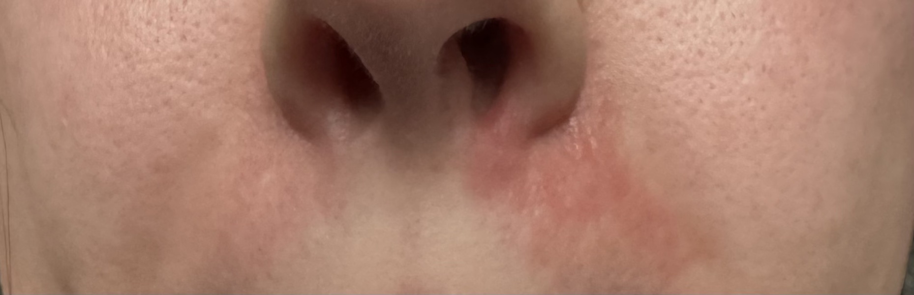 Skin problem on face.. PLEASE help (pictures)