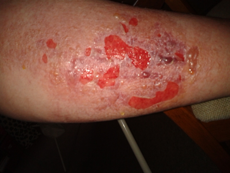 Had a nasty reaction to deep heat, not sure if I need to go to a&e or GP’s