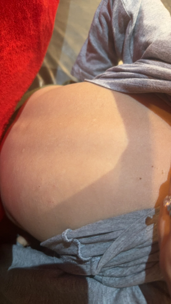 Help- how can I stop my sons awful case of chicken pox scarring