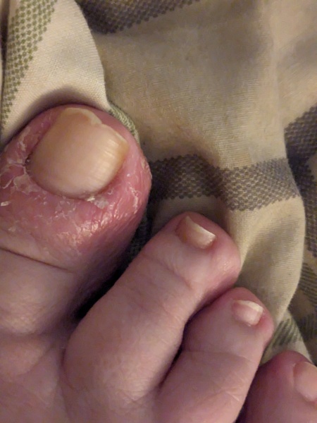 What cream to use on this ore toe ?