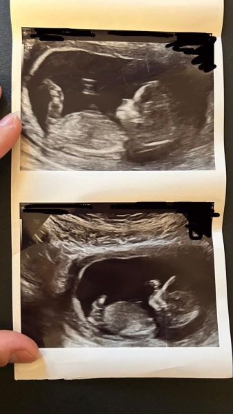 Skull theory 12 week scan