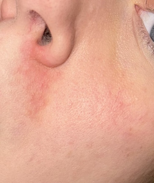 Red and sore area around nose?!
