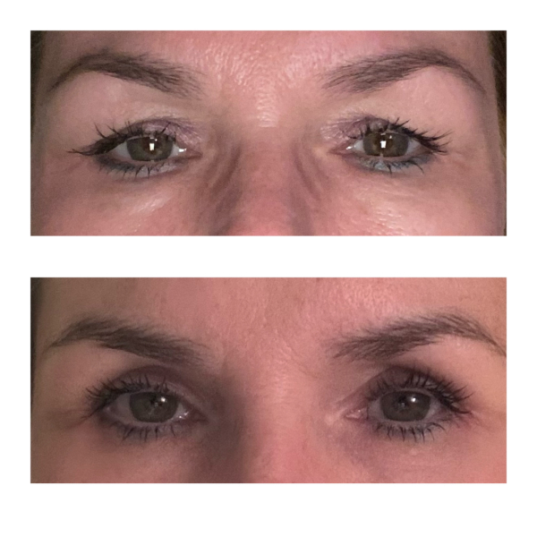 Blepharoplasty with local anesthesia
