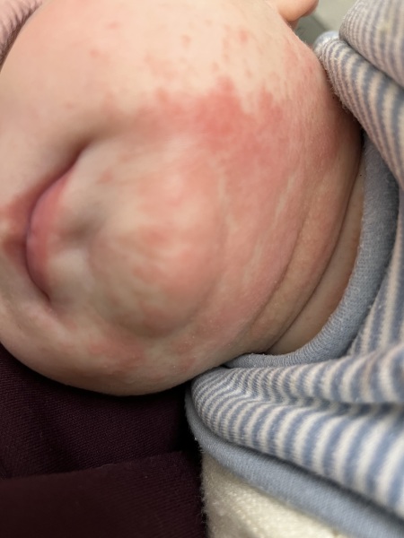 Dribble rash that won’t shift!