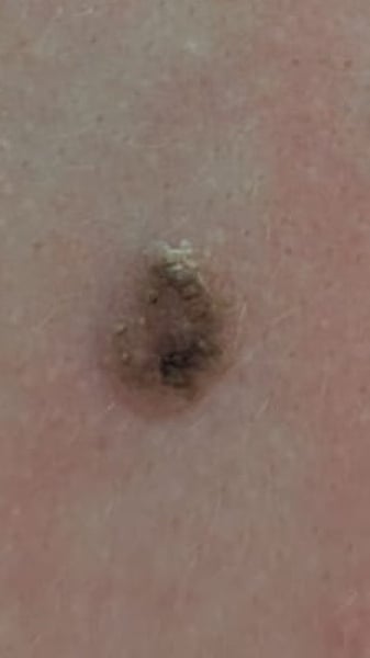 Is this mole anything to worry about?!