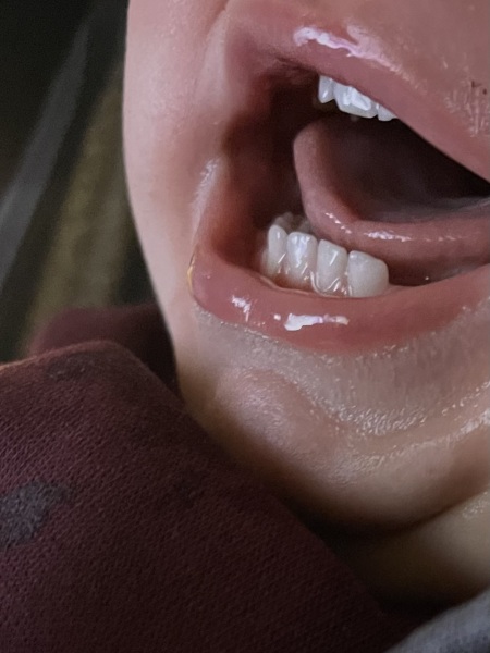 Tounge tie reattachment p