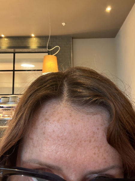 Tretinoin 0.006 - I think I can see an improvement already!! (Pic)